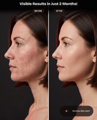 Revival Aura visible results in just 2 months, profile before and after skin comparison